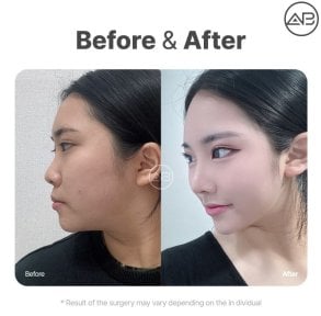 Resultado antes y después de rinoplastia de revisión en AB Plastic Surgery, perfil nasal mejorado