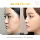 Resultados de antes y después de rinoplastia secundaria en AB Plastic Surgery, perfil nasal mejorado