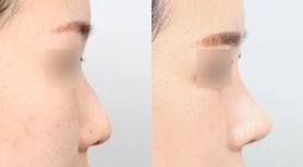Resultado antes y después de rinoplastia secundaria en AB Plastic Surgery, perfil nasal mejorado