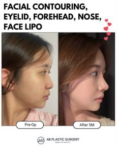 Contorno facial, párpados, nariz, frente, lipo facial antes y después en AB Plastic Surgery