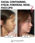 Contorno facial, párpados, nariz, frente, lipo facial antes y después en AB Plastic Surgery