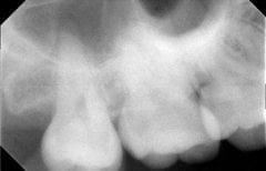 نتيجة إزالة ضرس العقل بالأشعة في SoftDentalCare Clinic مع شفاء ما بعد الخلع