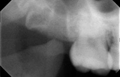 أشعة سينية قبل خلع ضرس العقل في SoftDentalCare Clinic، يظهر السن المطمور