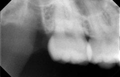 نتيجة الأشعة بعد خلع ضرس العقل في SoftDentalCare Clinic، تحسن صحة الأسنان