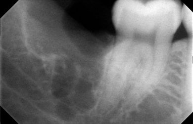 أشعة سينية قبل خلع ضرس العقل في SoftDentalCare Clinic، نتيجة تخطيط العلاج