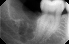 أشعة سينية قبل خلع ضرس العقل في SoftDentalCare Clinic، نتيجة تخطيط العلاج