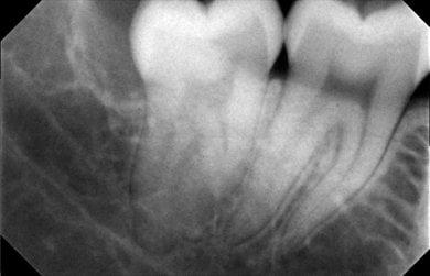أشعة سينية قبل خلع ضرس العقل في SoftDentalCare Clinic، يظهر السن المطمور