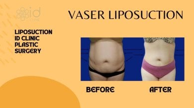 before-after photo liposuction