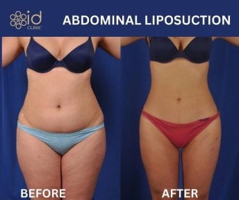 before-after photo liposuction