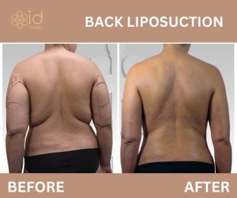 before-after photo liposuction