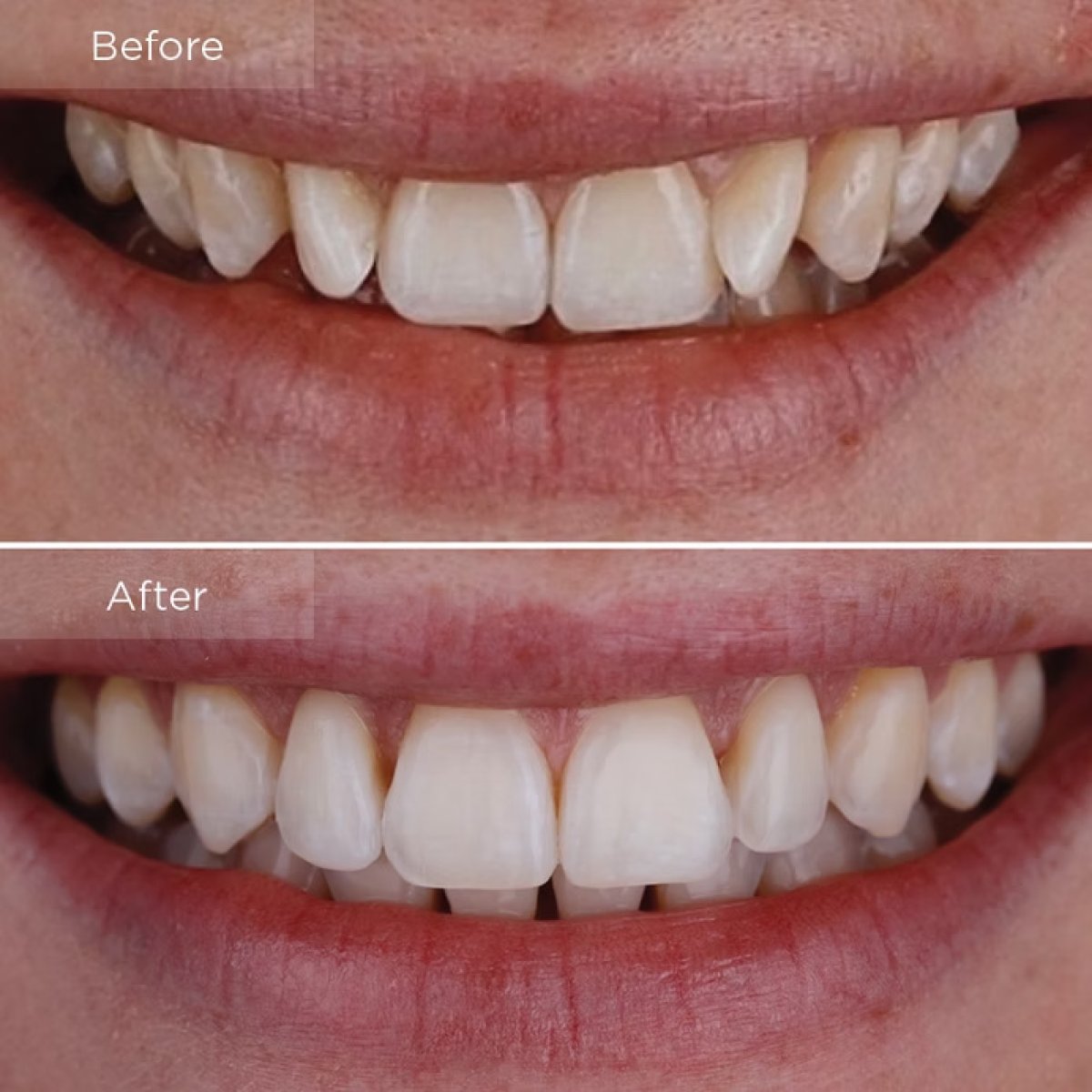 نتائج تبييض الأسنان قبل وبعد في Funda Sarıkaya Diş Polikliniği - Dental Clinic أنقرة
