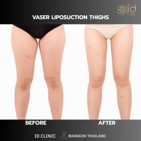 before-after photo mommy-makeover