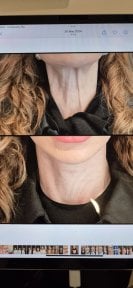 Resultados de lifting de cuello antes y después en Memorial Ataşehir Hospital – cuello más firme