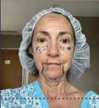 Preparación para lifting de cuello en Memorial Ataşehir Hospital, marcas quirúrgicas previas