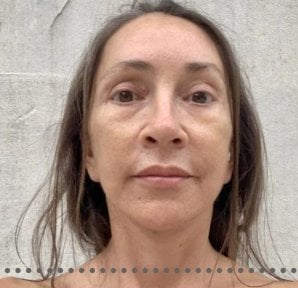 Resultado de lifting de cuello en Memorial Ataşehir Hospital, piel más firme y rejuvenecida