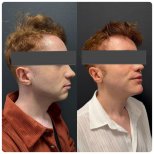 Before and after sliding genioplasty results at Memorial Şişli Hospital, improved chin profile