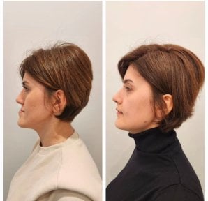 Before and after sliding genioplasty results at Memorial Şişli Hospital, improved chin profile