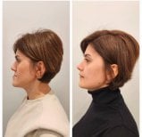 Before and after sliding genioplasty results at Memorial Şişli Hospital, improved chin profile