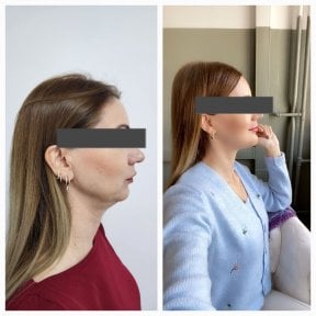 Before and after sliding genioplasty results at Memorial Şişli Hospital, improved chin profile