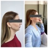 Before and after sliding genioplasty results at Memorial Şişli Hospital, improved chin profile