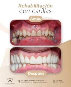 before-after photo smile-makeover