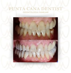 before-after photo smile-makeover