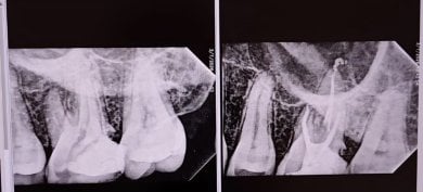 before-after photo root-canal-treatment