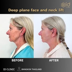 نتائج شد الوجه والرقبة العميق قبل وبعد في ID Clinic Bangkok