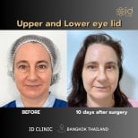 نتائج جراحة الجفن العلوي والسفلي في ID Clinic Bangkok بعد 10 أيام من العملية