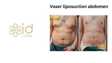 نتائج شفط الدهون فايزر للبطن قبل وبعد في ID Clinic Bangkok مع تقليل الدهون بوضوح