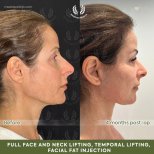Before and after neck lift results at Dr. Safa Manav Clinic, visible neck contour improvement