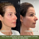 Neck lift before and after results at Dr. Safa Manav Clinic – visible neck contour improvement