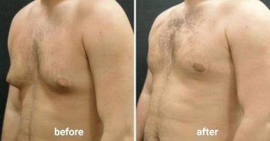 نتائج شفط الدهون 360 قبل وبعد في ID Clinic Bangkok، تحسين شكل صدر الرجل