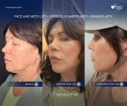 Before and after face and neck lift, blepharoplasty, rhinoplasty at Dr. Safa Manav Clinic