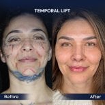 Before and after temporal lift results at Dr. Safa Manav Clinic, facial rejuvenation procedure