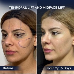 Before and after endoscopic facelift results at Dr. Safa Manav Clinic, visible facial lift