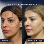 Before and after endoscopic facelift results at Dr. Safa Manav Clinic, visible facial lift