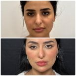 Before and after endoscopic facelift results at Dr. Safa Manav Clinic, facial rejuvenation