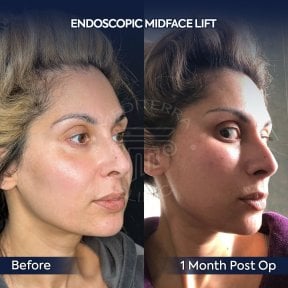 Before and after endoscopic facelift results at Dr. Safa Manav Clinic, visible facial lift