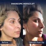 Before and after endoscopic facelift results at Dr. Safa Manav Clinic, visible facial lift
