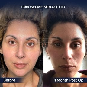 Before and after endoscopic facelift results at Dr. Safa Manav Clinic, visible midface lift