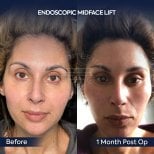 Before and after endoscopic facelift results at Dr. Safa Manav Clinic, visible midface lift