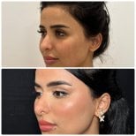 Before and after endoscopic facelift results at Dr. Safa Manav Clinic, facial rejuvenation