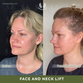 Before and after deep plane facelift results at Dr. Safa Manav Clinic, face and neck lift