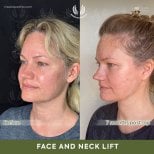 Before and after deep plane facelift results at Dr. Safa Manav Clinic, face and neck lift