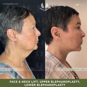 Before and after face and neck lift, blepharoplasty results at Medolea Clinic, 8 months post-op