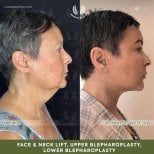 Before and after face and neck lift, blepharoplasty results at Medolea Clinic, 8 months post-op
