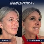 Before and after deep plane facelift and neck lift results at Dr. Safa Manav Clinic