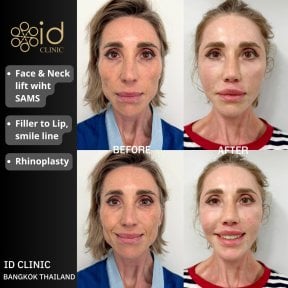 before-after photo abdominoplasty