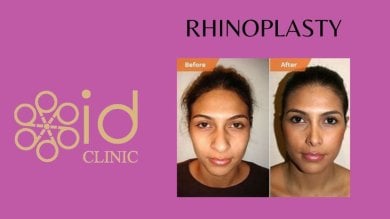 before-after photo abdominoplasty